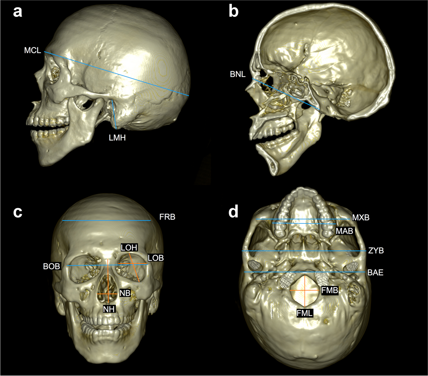 Estimation of ancestry from cranial measurements based on MDCT data acquired in a Japanese and Western Australian population