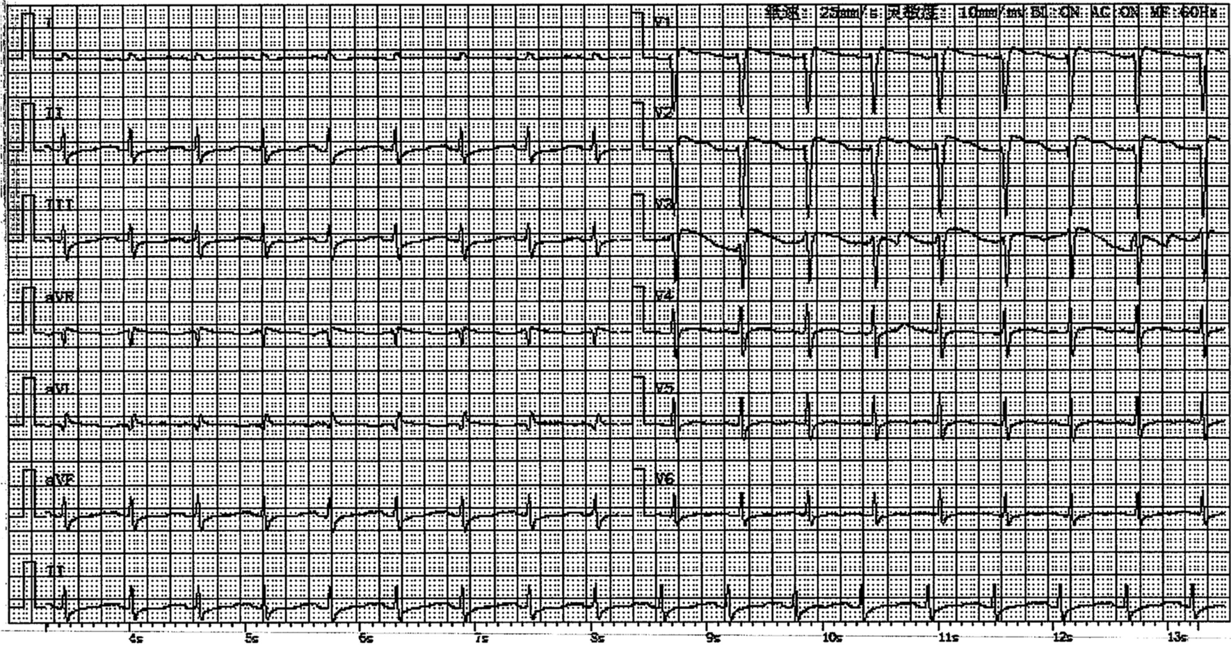 Cardiogenic shock in a 28-year-old woman associated with sibutramine use