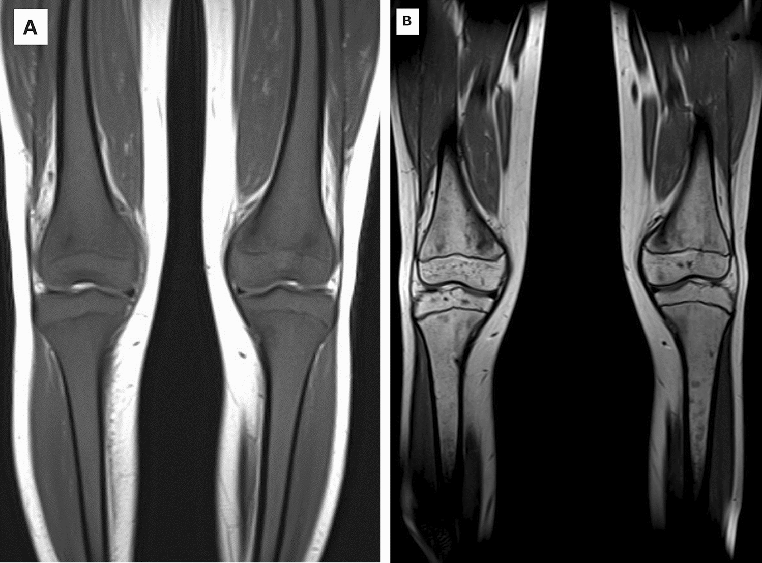 Abnormal bone marrow T1-weighted MRI images in a pediatric patient with acute lymphoblastic leukemia without peripheral blasts