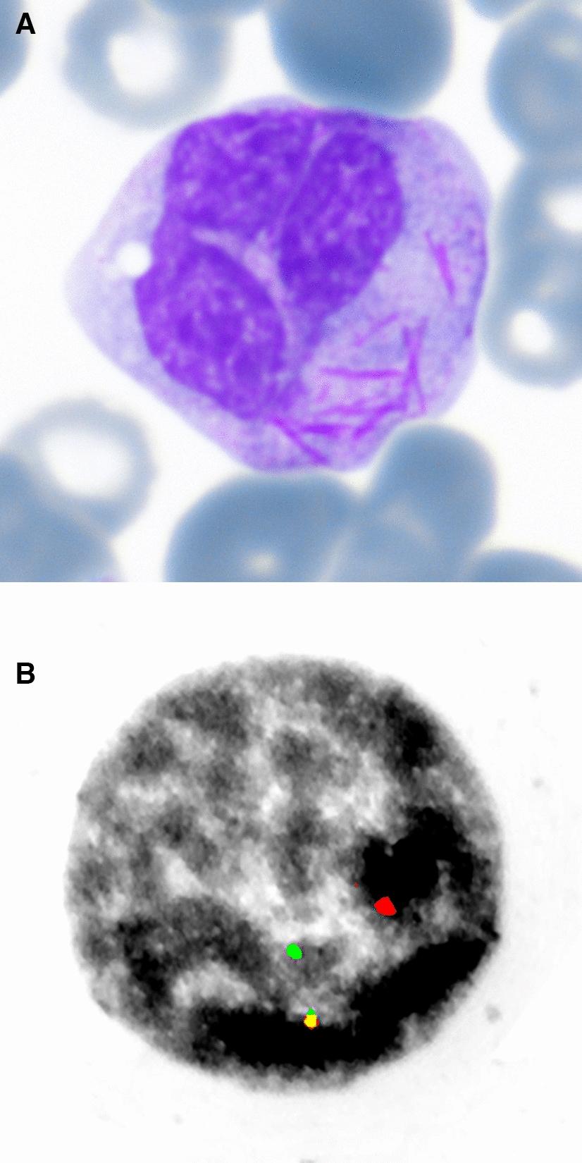 Auer rods in mature granulocytes in peripheral blood