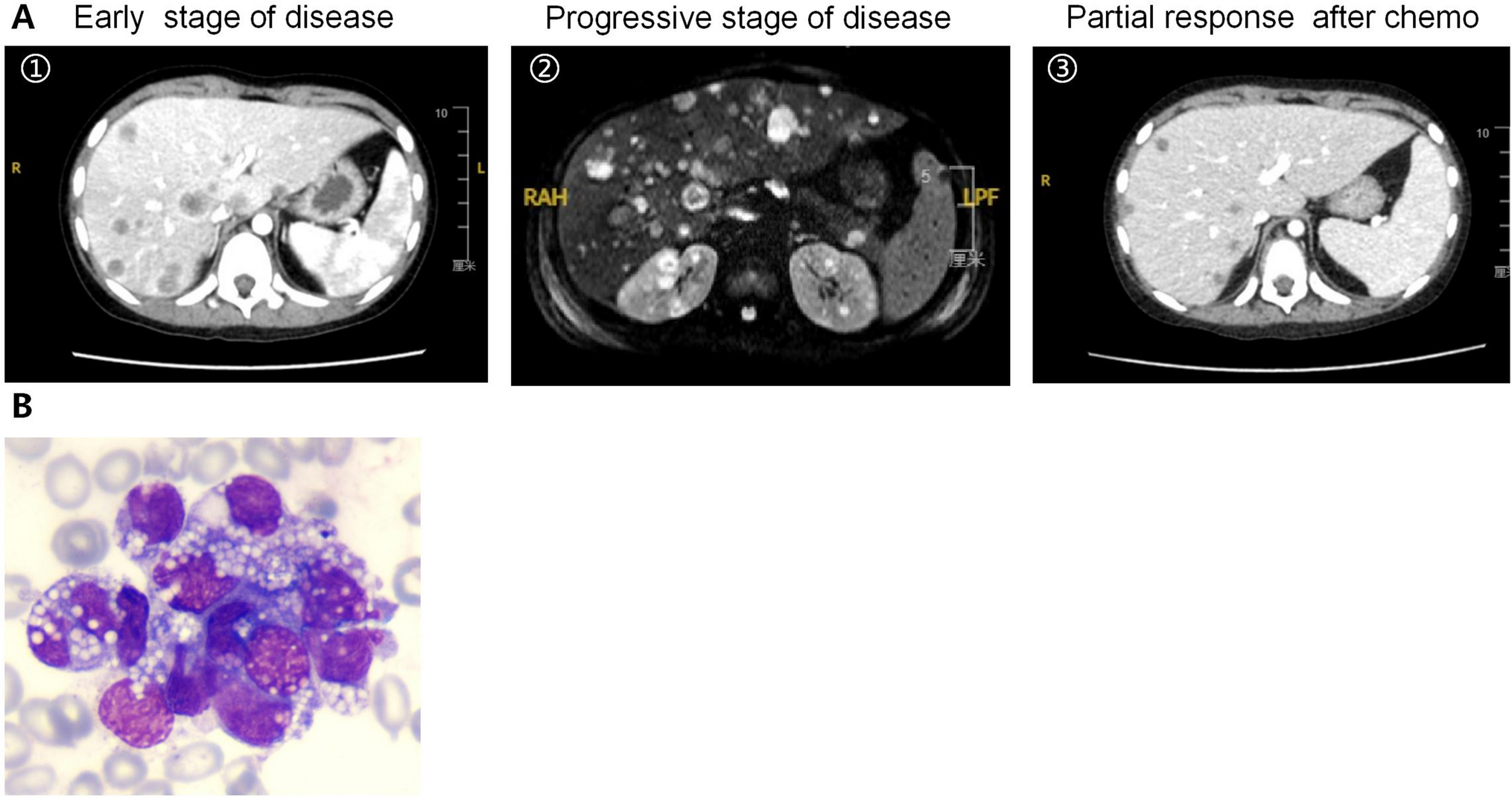 Histiocytic sarcoma following CAR T-cell therapy: a case report