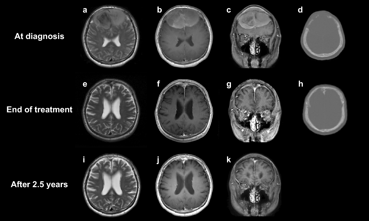 Diffuse large B-cell lymphoma of the skull vault
