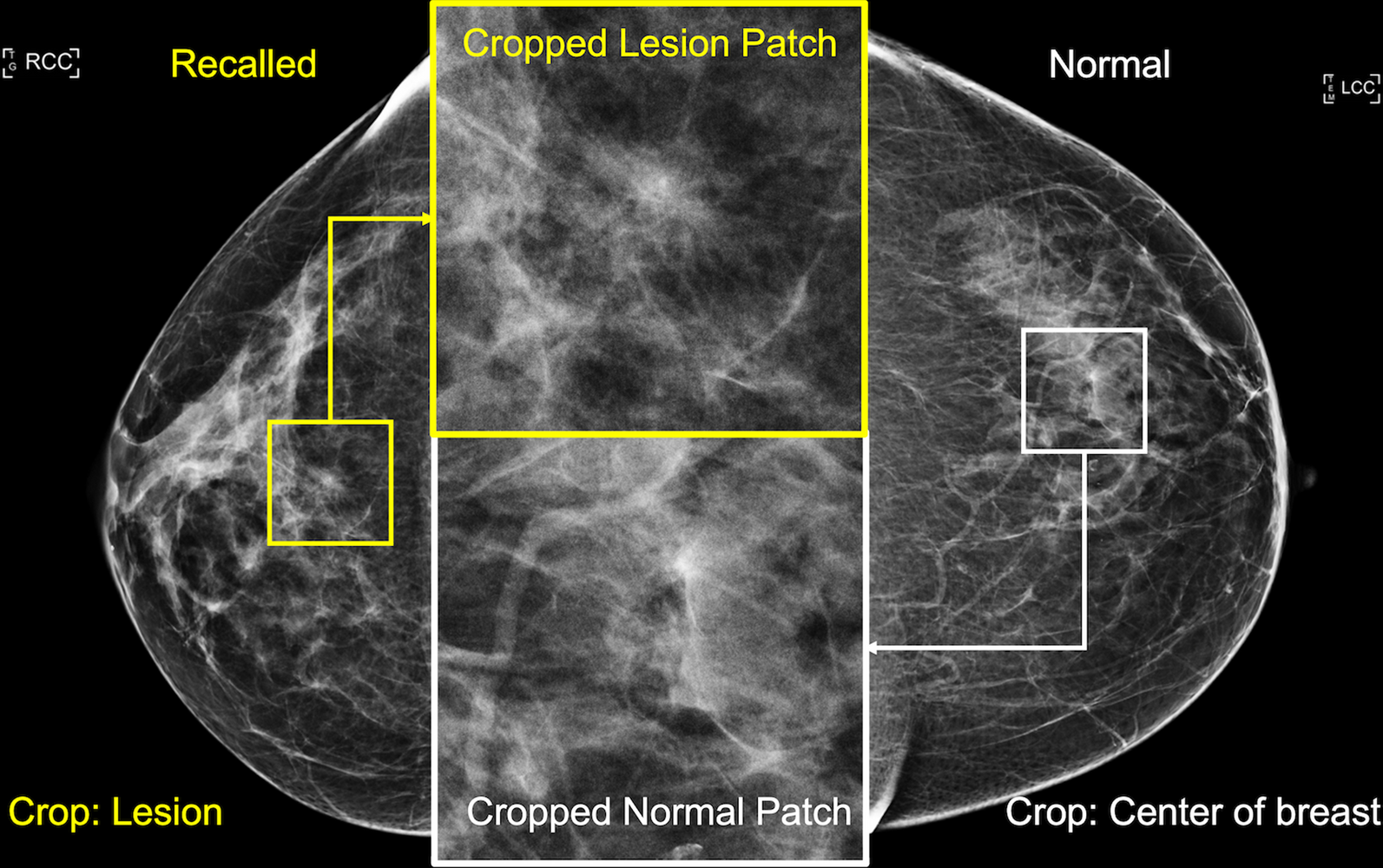 Improving lesion detection in mammograms by leveraging a Cycle-GAN-based lesion remover
