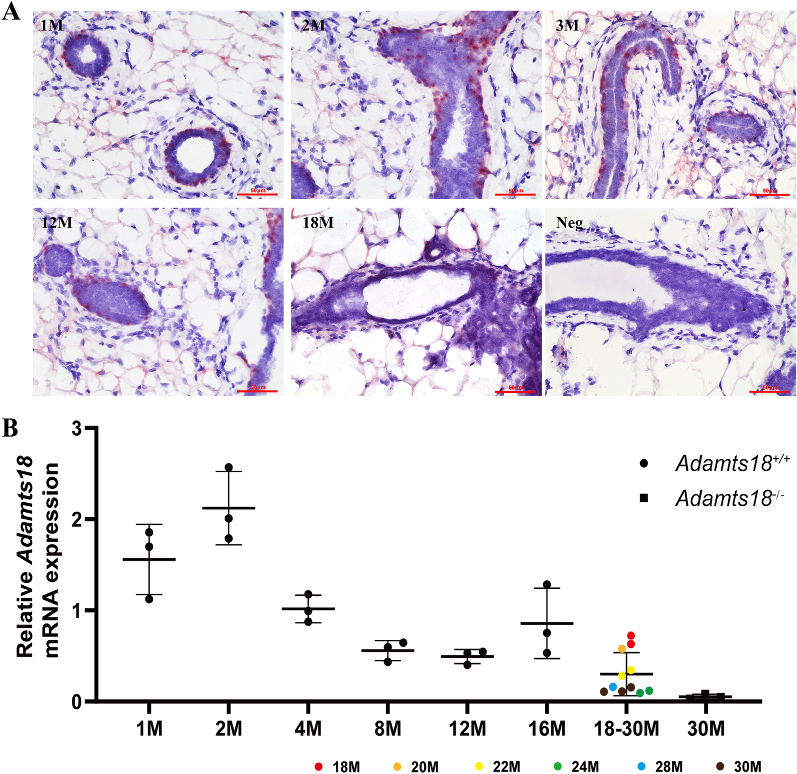ADAMTS18 deficiency associates extracellular matrix dysfunction with a higher risk of HER2-positive mammary tumorigenesis and metastasis