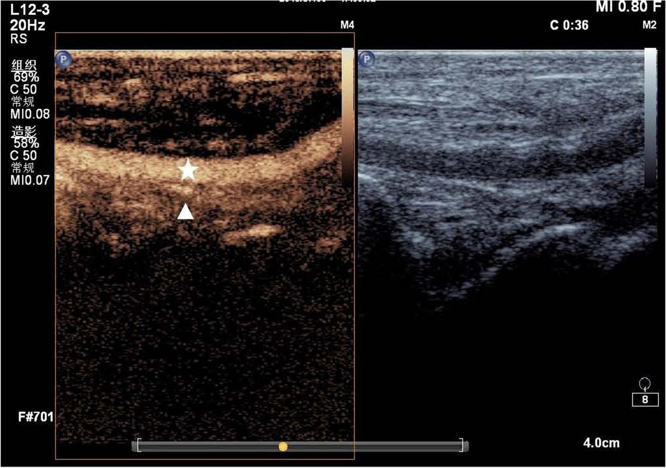The value of contrast-enhanced ultrasound in the diagnosis of microcirculatory perfusion abnormalities in diabetic foot