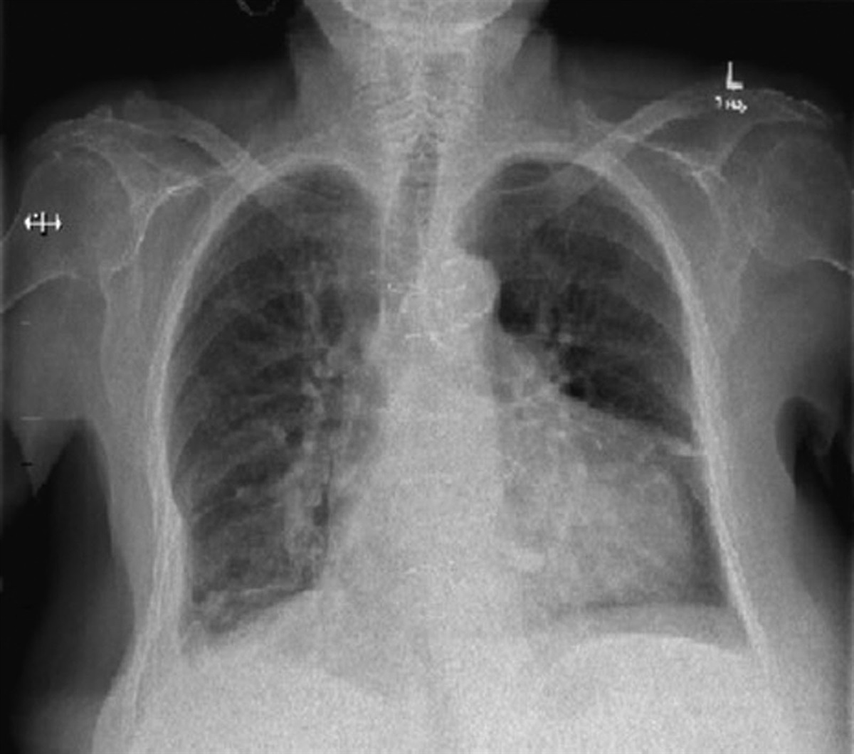 Ventilation-perfusion scan for diagnosing pulmonary embolism: do chest x-rays matter?