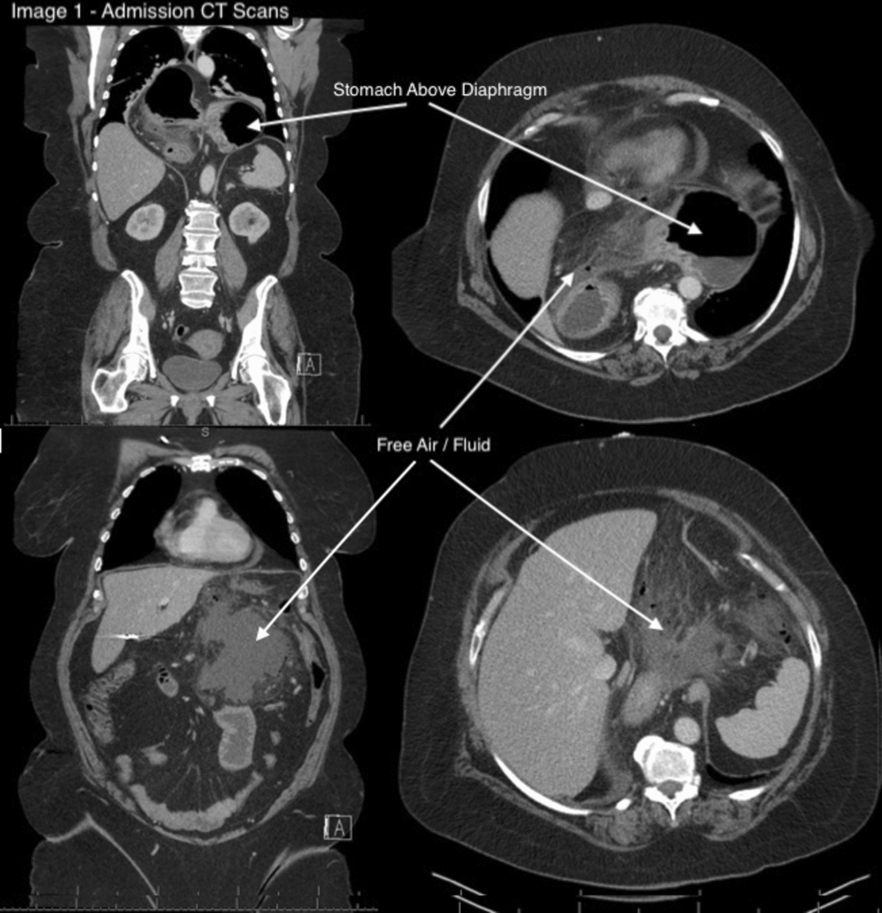 Successful Surgical Management of a Perforated Duodenal Ulcer Within an Incarcerated Paraesophageal Hernia