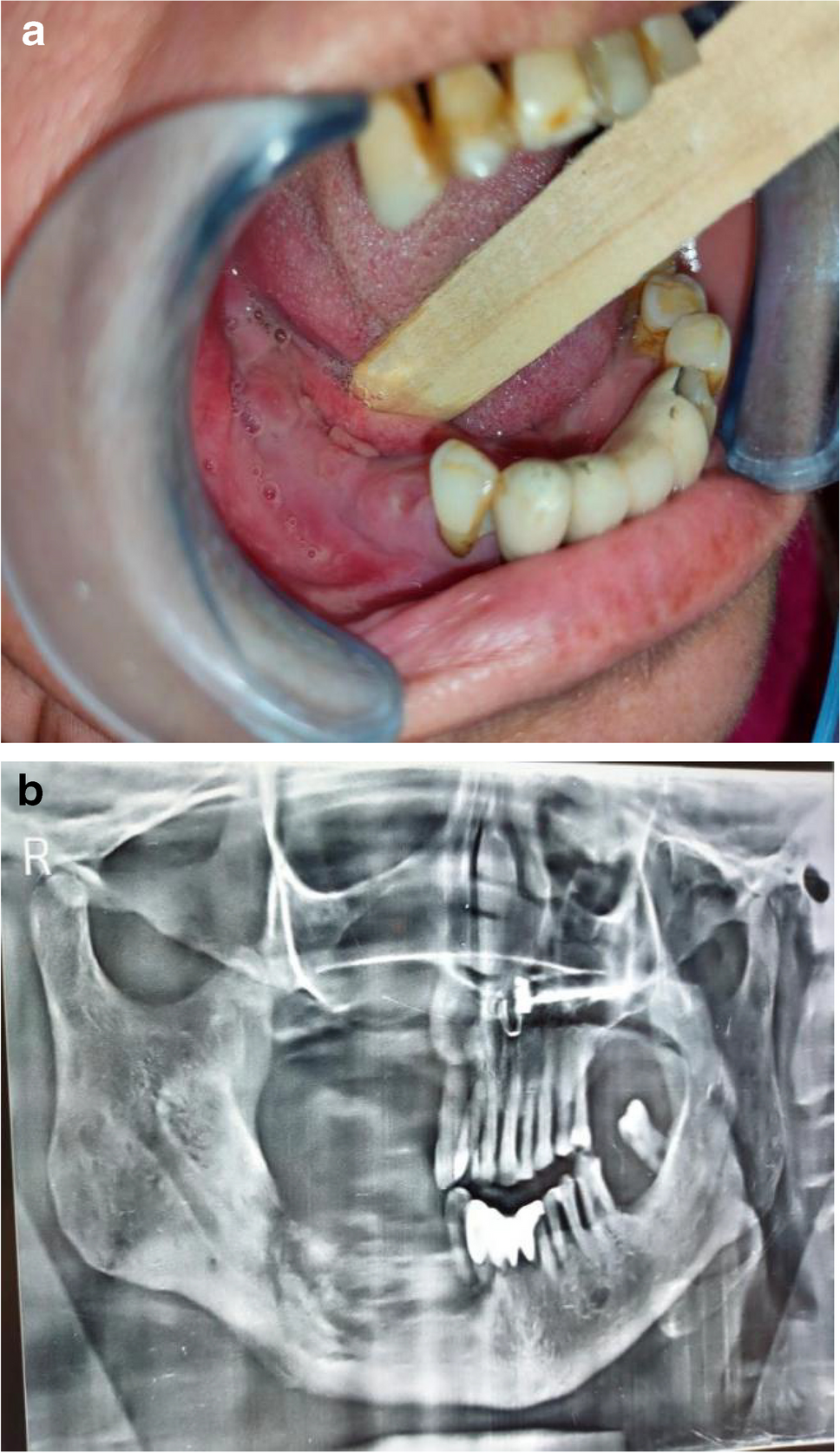Debridement using Piezosurgical Device and Incorporation of Autologous Platelet-Rich Fibrin in Management of Stage III Medication-Related Osteonecrosis of the Jaw — A Case study and Review of Literature