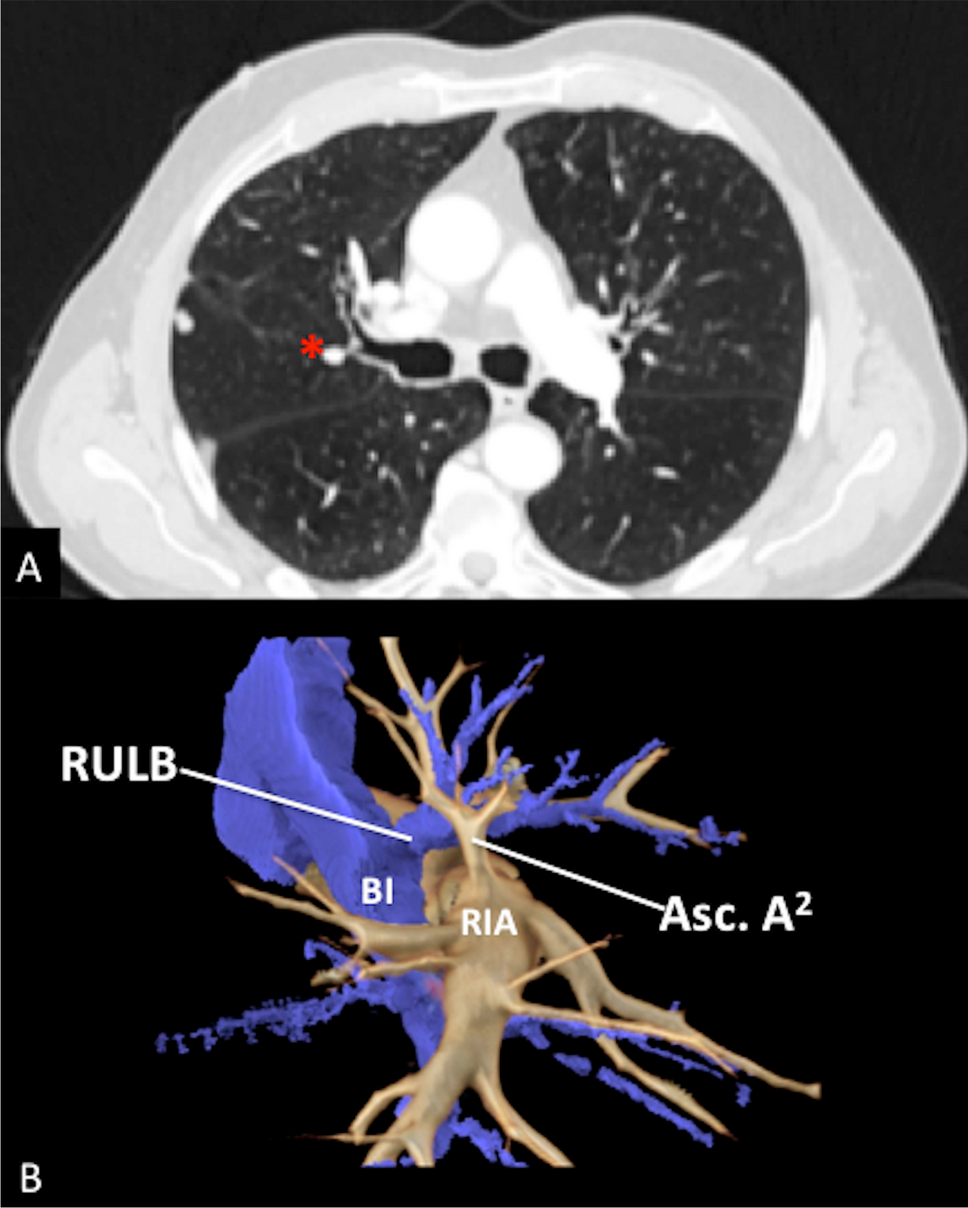 Identification of Anomalous Asc. A2 Using Three-Dimensional Chest Computed Tomography Reconstruction