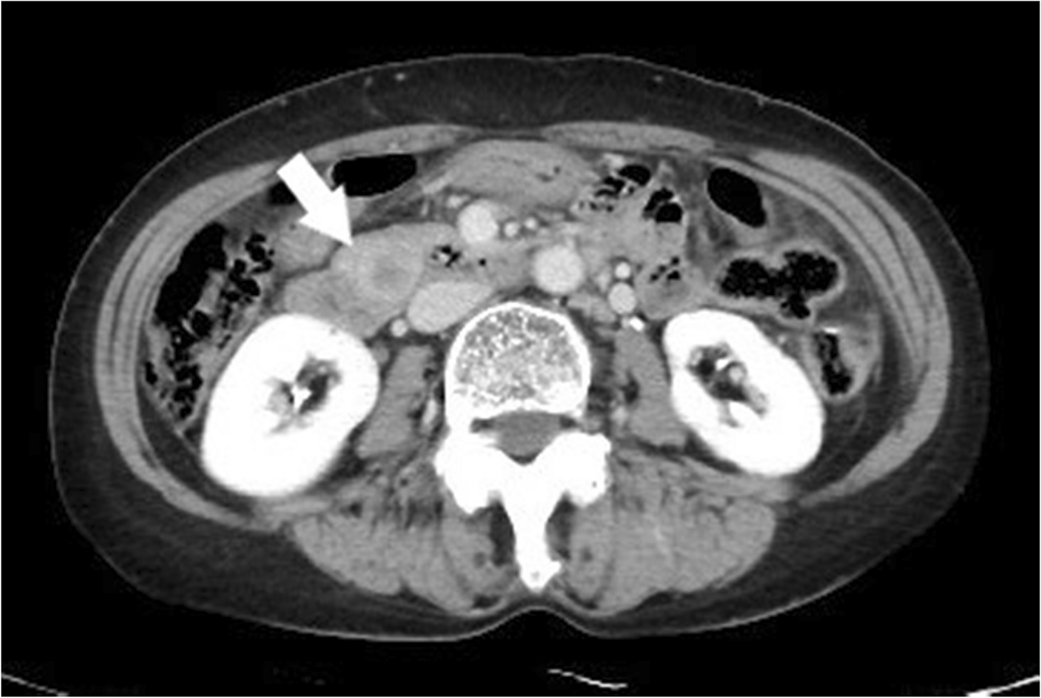Segmental Duodenal Resection for Gastrointestinal Stromal Tumor