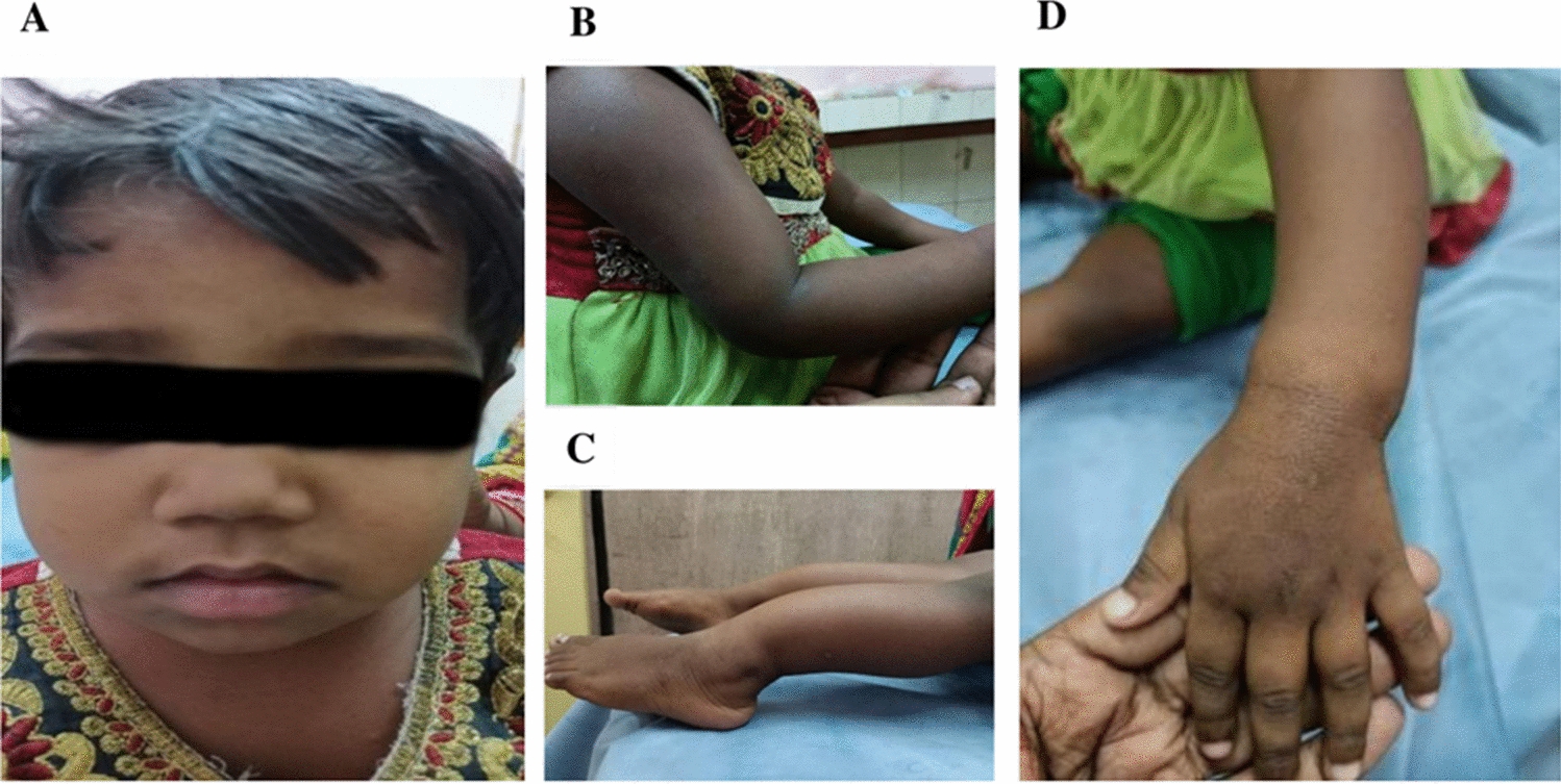 Identification of a Novel Homozygous Missense Mutation in the CLDN16 Gene to Decipher the Ambiguous Clinical Presentation Associated with Autosomal Dominant Hypocalcaemia and Familial Hypomagnesemia with Hypercalciuria and Nephrocalcinosis in an Indian Family