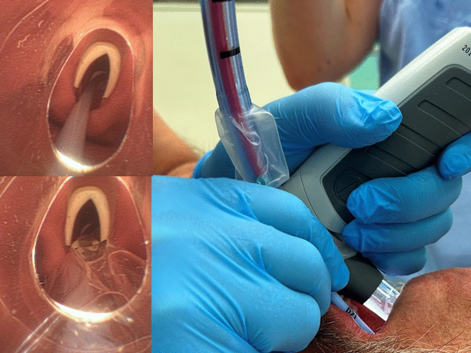 Parallel intubation technique with the Vie Scope® laryngoscope