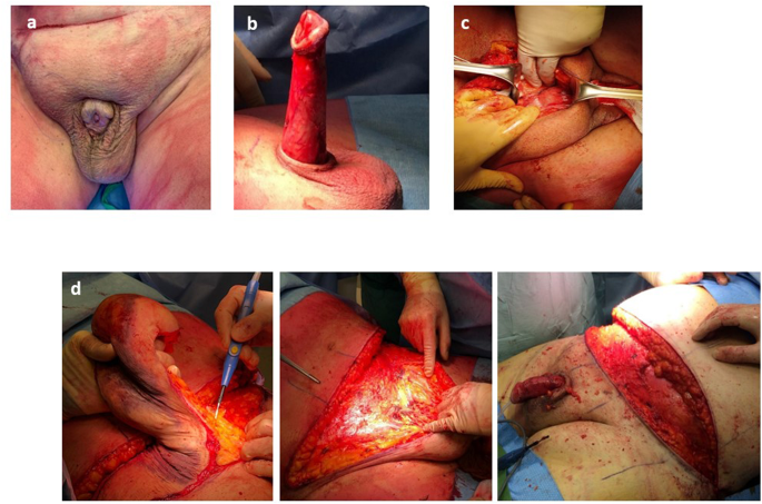 No difference between split-thickness and full-thickness skin grafts for surgical repair in adult acquired buried penis regarding surgical and functional outcomes: a comparative retrospective analysis