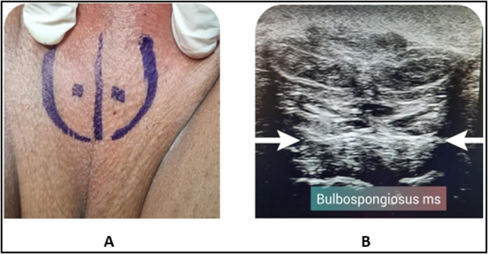 Effect of bulbospongiosus muscle injection with botulinum-A toxin for treatment of lifelong premature ejaculation; a randomized controlled trial