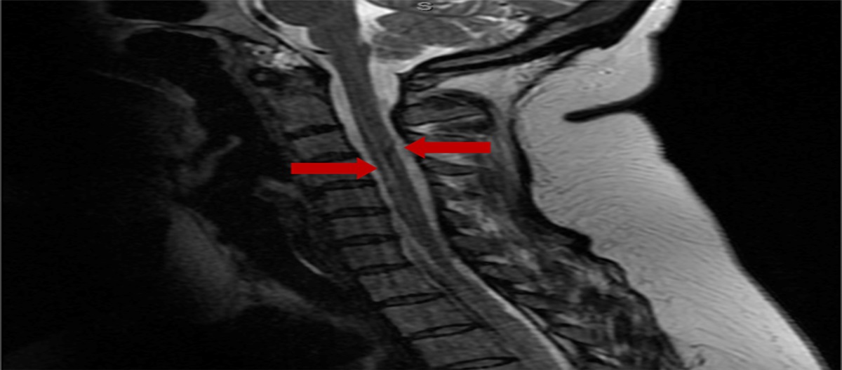 Subacute Combined Degeneration of the Spinal Cord Induced by Nitrous Oxide Abuse: A Rare Patient Presentation to a Spine Surgery Clinic: Illustrative Case