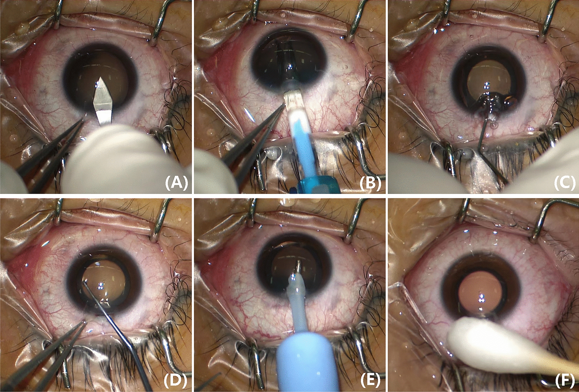 The effect of irrigation and aspiration on the corneal endothelial cell density in patients undergoing Implantable Collamer Lens with a central hole implantation for myopia correction
