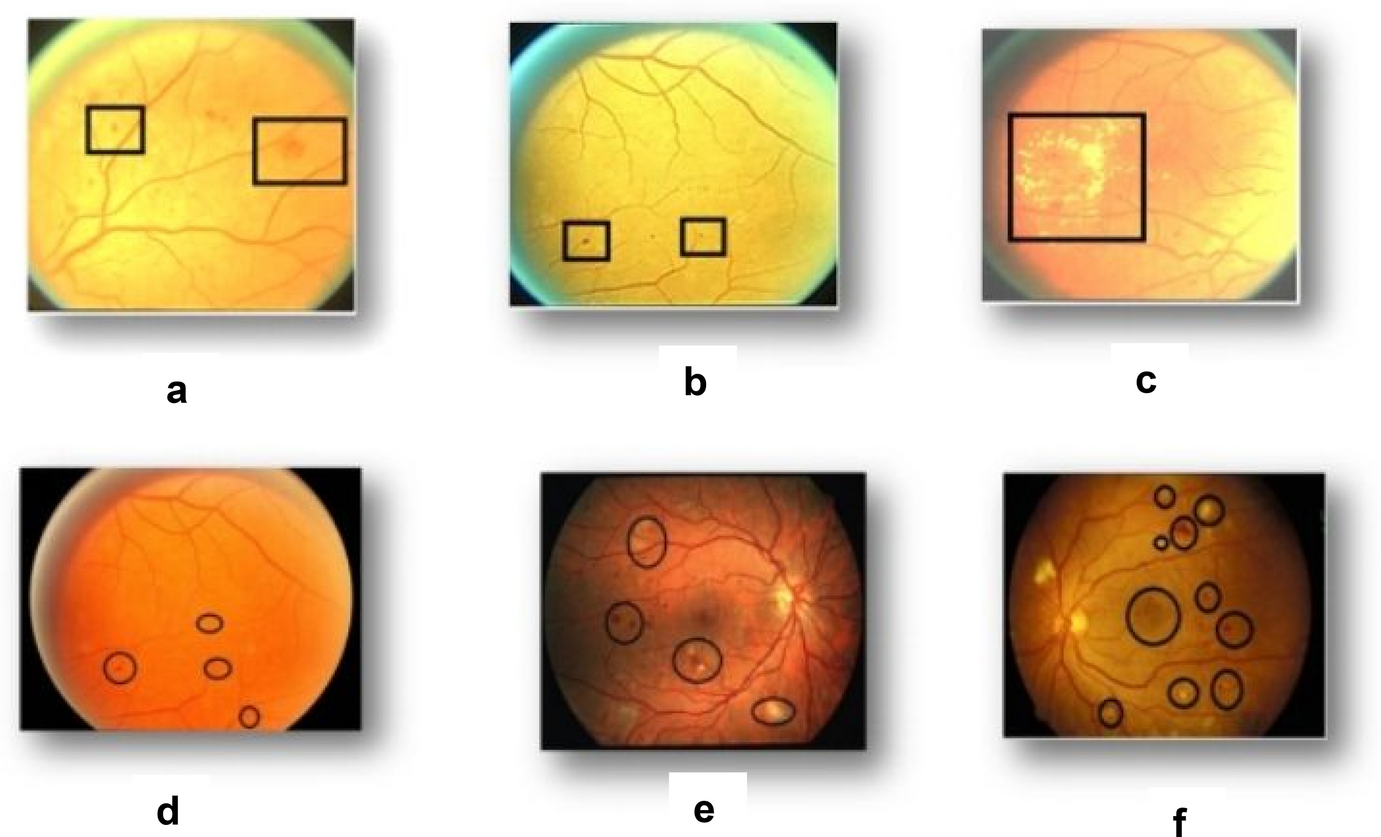 Exploration of AI-powered DenseNet121 for effective diabetic retinopathy detection