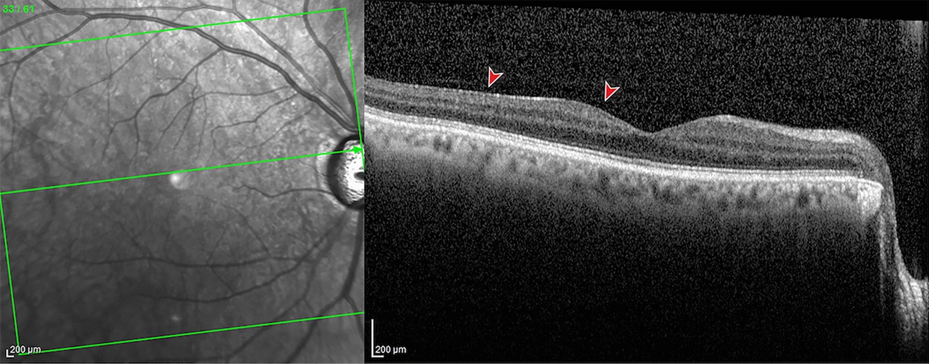 Epiretinal membrane development after Ex-Press glaucoma filtration device implant: 2-year results of a case control study
