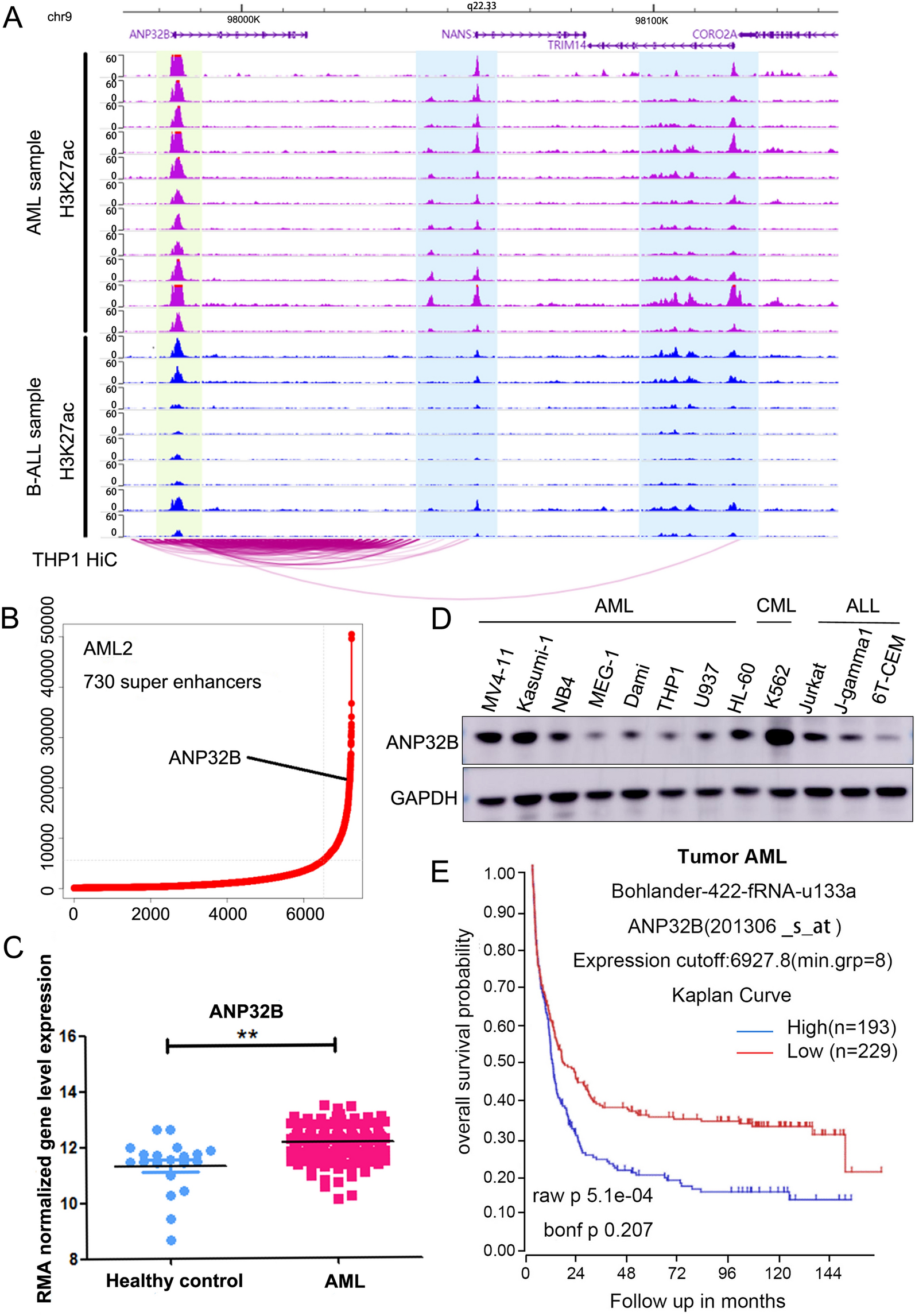 Super enhancer related gene ANP32B promotes the proliferation of acute myeloid leukemia by enhancing MYC through histone acetylation