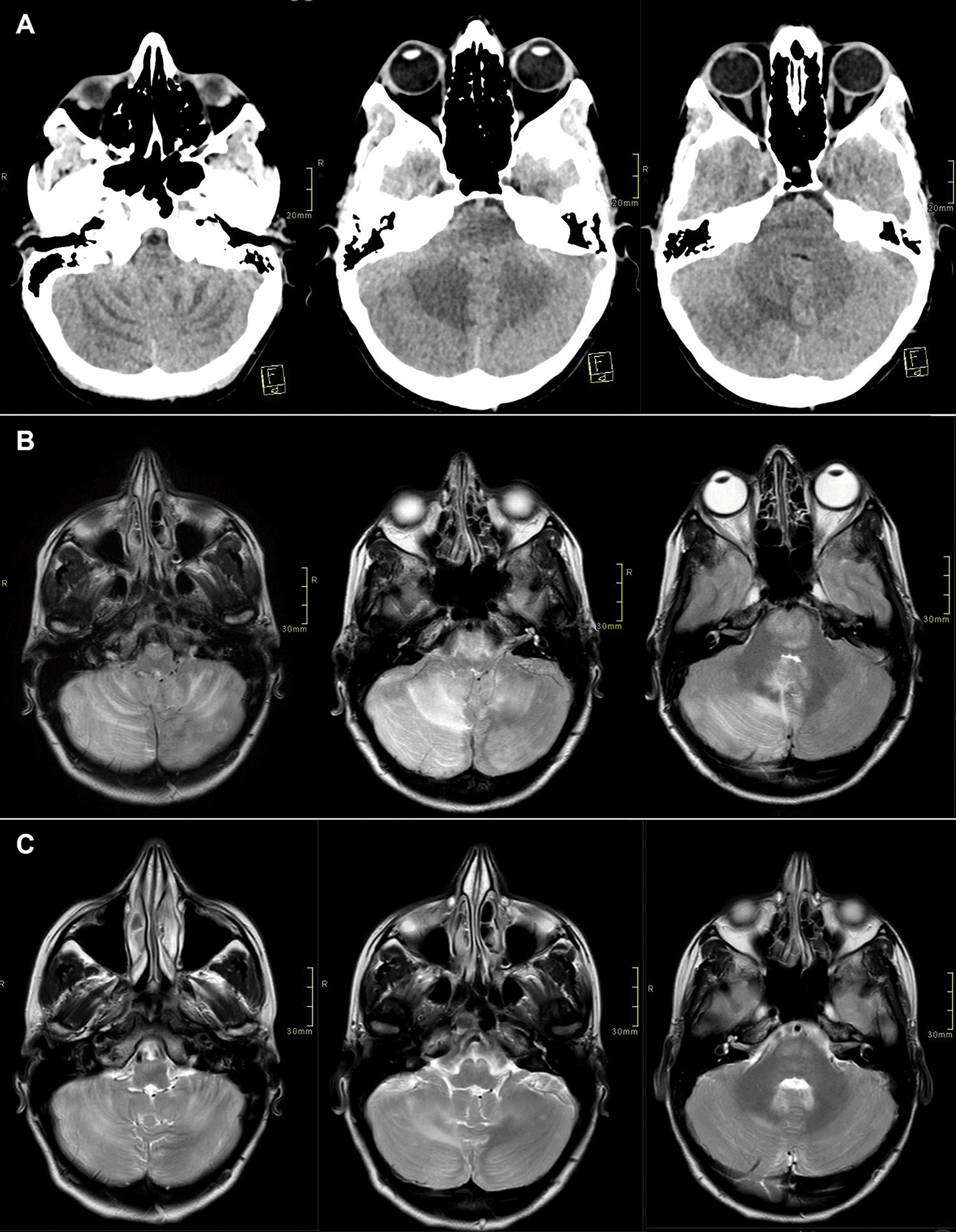 Infratentorial posterior reversible encephalopathy syndrome in INFβ1a-treated multiple sclerosis patient