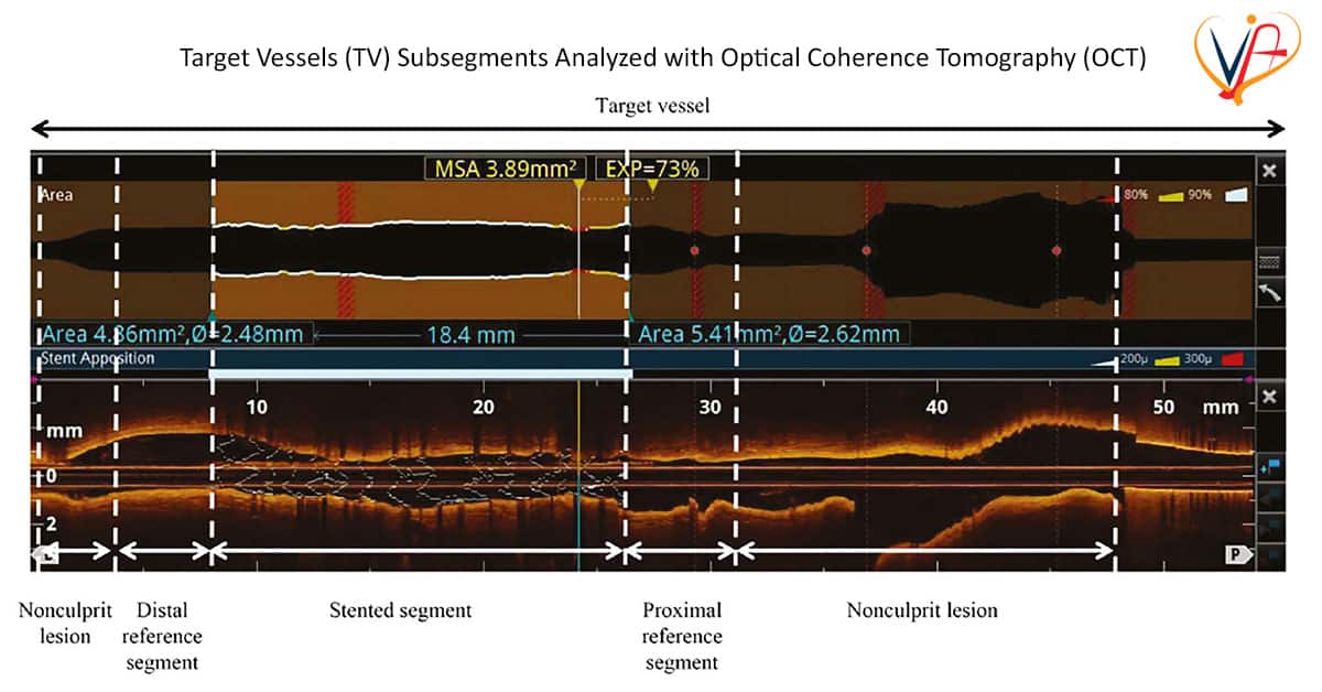 Prognostic Value of Optical Flow Ratio among Patients with Coronary Artery Disease after Percutaneous Coronary Treatment: A Hospital-Based Retrospective Cohort Investigation