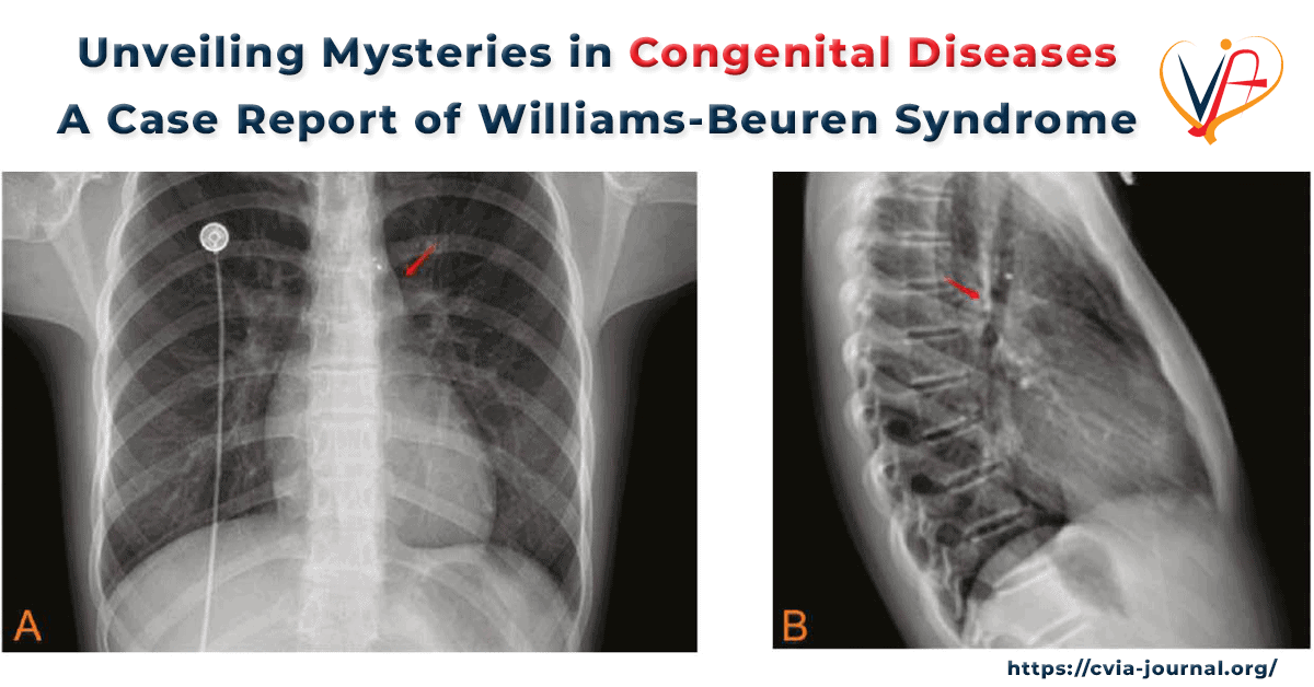 Unveiling Mysteries in Congenital Diseases: A Case Report of Williams-Beuren Syndrome