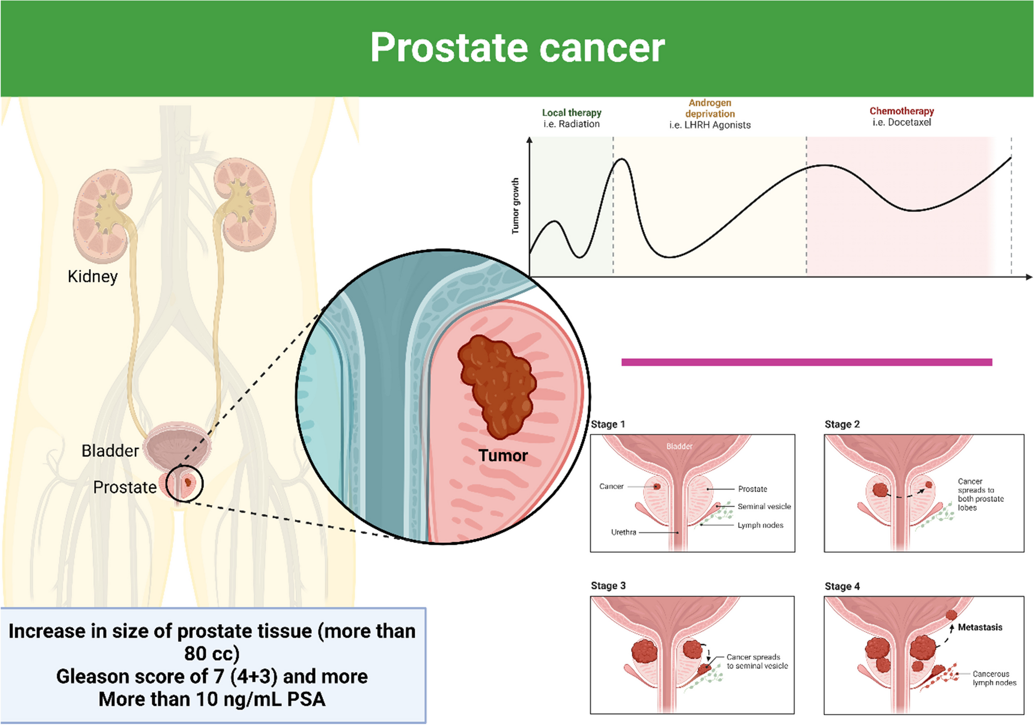 Molecular panorama of therapy resistance in prostate cancer: a pre-clinical and bioinformatics analysis for clinical translation
