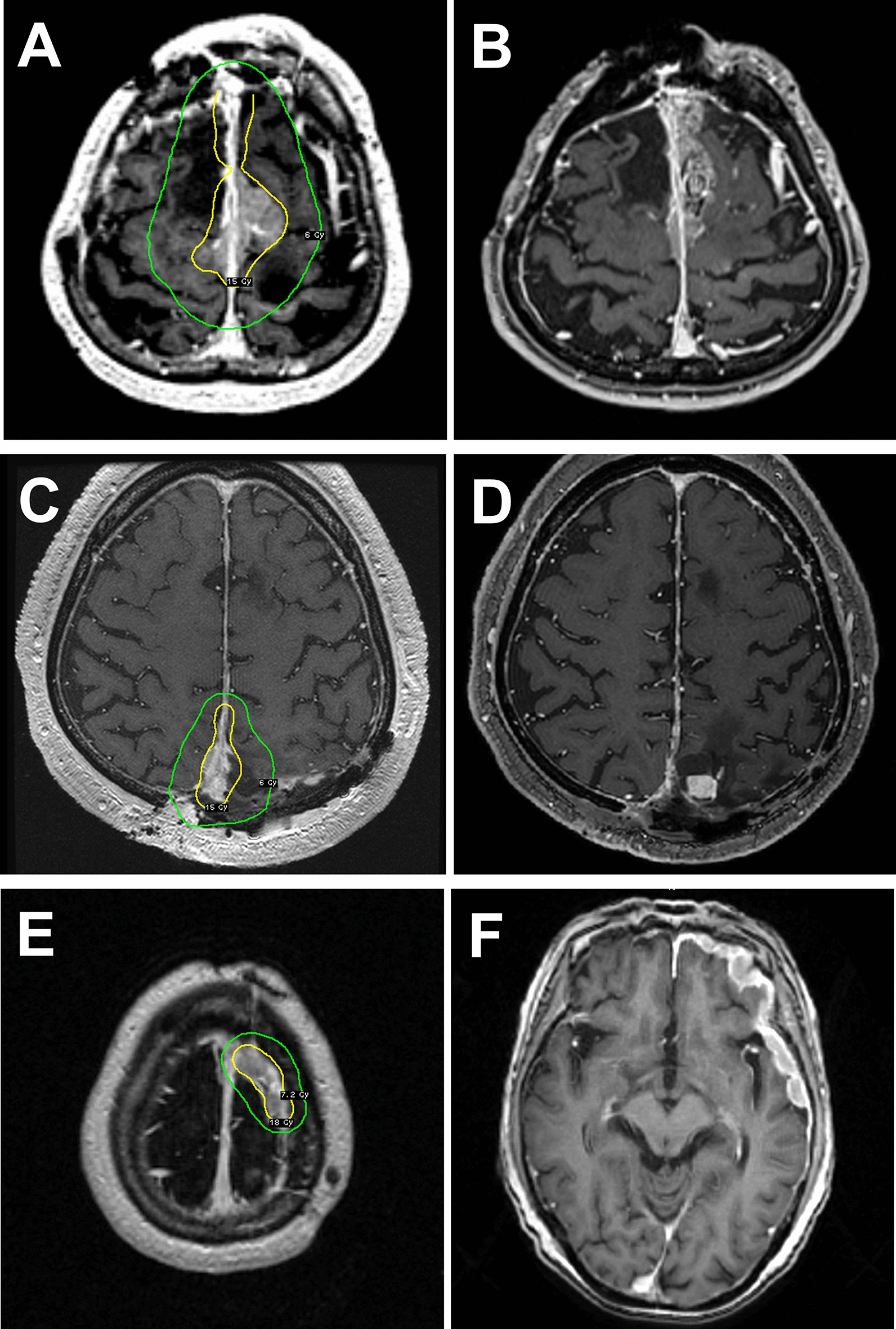 Ki-67 labeling index predicts tumor progression patterns and survival in patients with atypical meningiomas following stereotactic radiosurgery