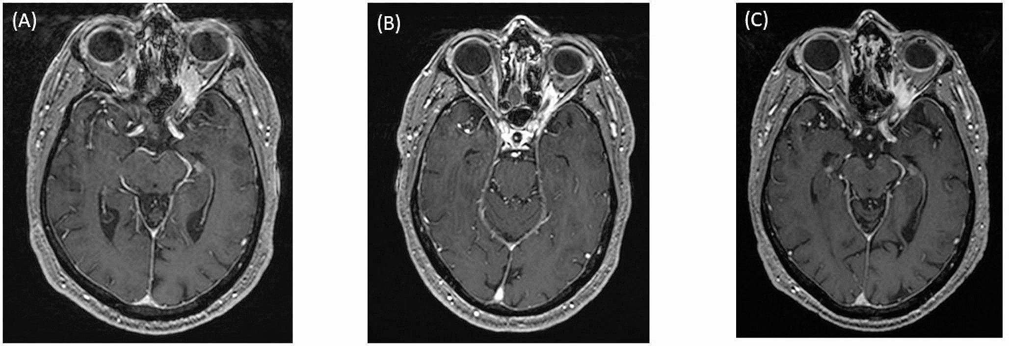 Stereotactic radiosurgery for intracranial adenoid cystic carcinoma