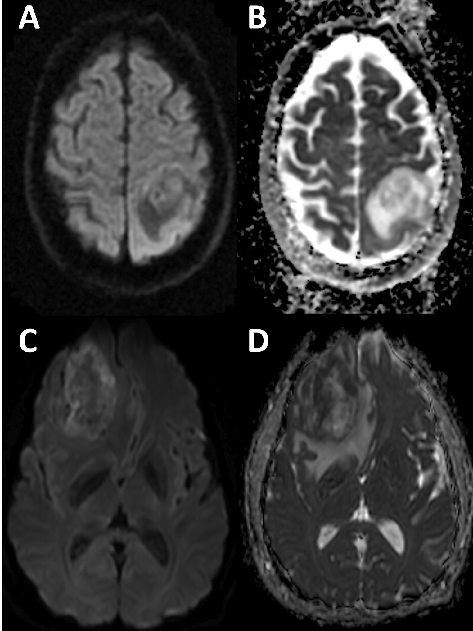 Imaging predictors of 4q12 amplified and RB1 mutated glioblastoma IDH-wildtype