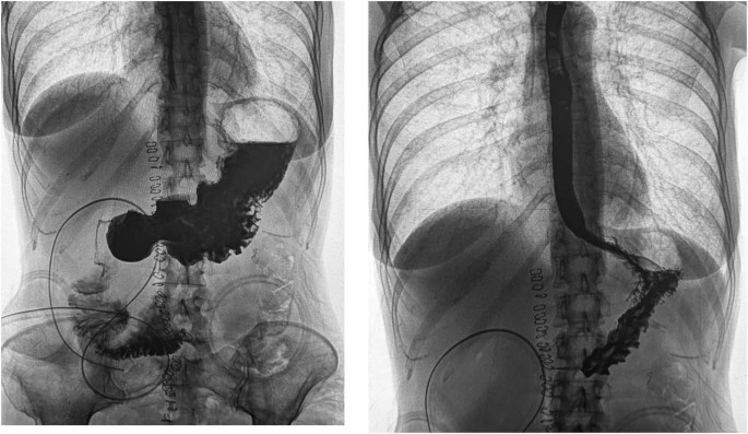 Managing fluid balance and nutritional status in a short bowel syndrome patient awaiting intestinal transplant: a case report