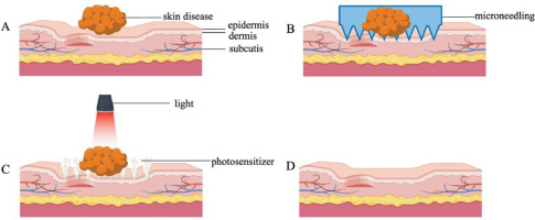 Application of Microneedling in Photodynamic Therapy: a Systematic Review
