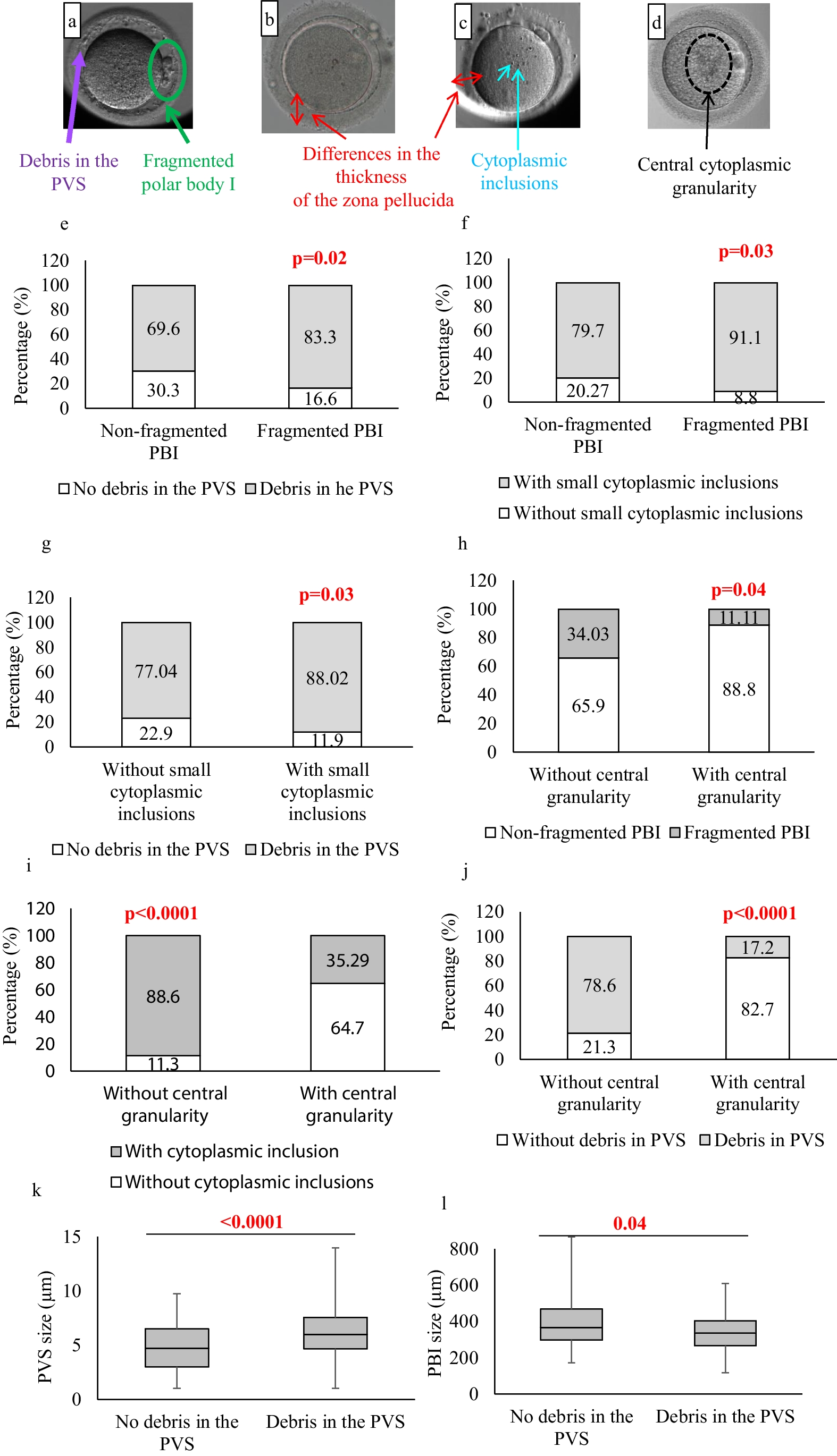 Mature oocyte dysmorphisms may be associated with progesterone levels, mitochondrial DNA content, and vitality in luteal granulosa cells
