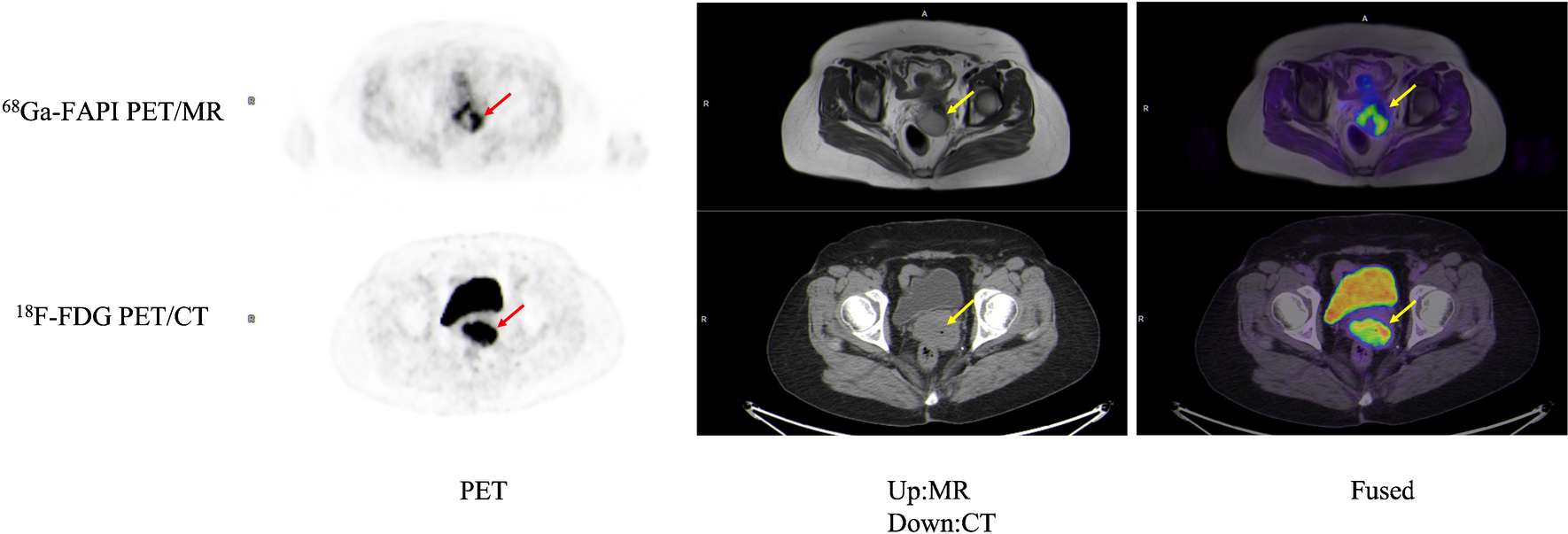 Comparison of the diagnostic value of [68 Ga]Ga-FAPI-04 PET/MR and [18F]FDG PET/CT in patients with T stage ≤ 2a2 uterine cervical cancer: a prospective study