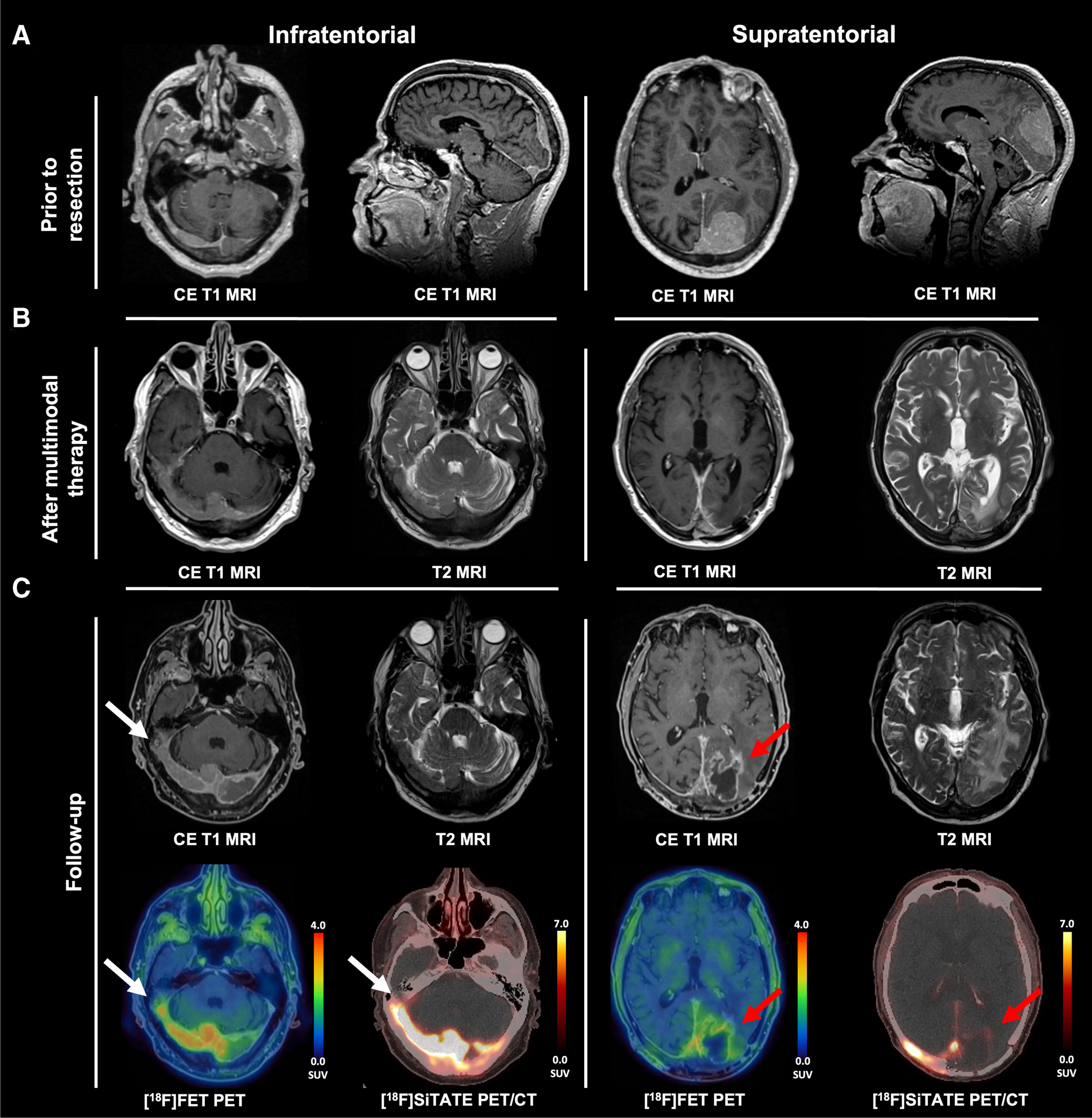The value of [18F]FET PET and somatostatin receptor imaging for differentiating pseudoprogression in residual meningioma