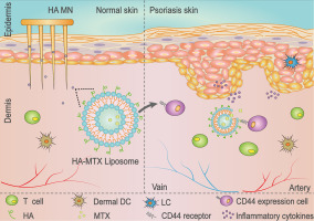 Methotrexate-loaded hyaluronan-modified liposomes integrated into dissolving microneedles for the treatment of psoriasis