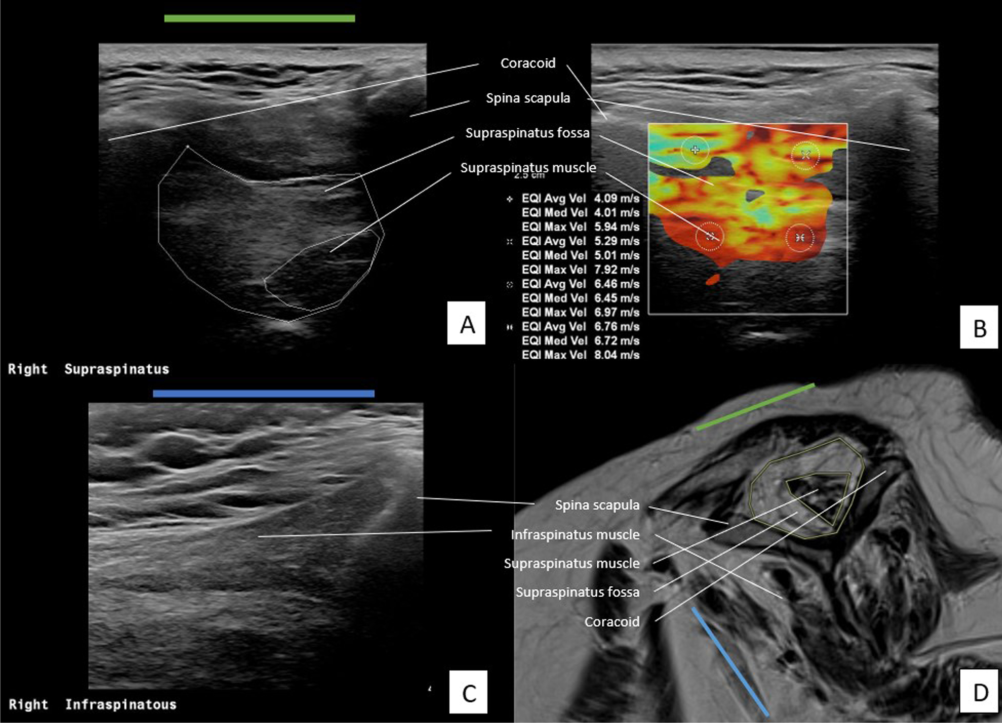 The validity of ultrasound and shear wave elastography to assess the quality of the rotator cuff