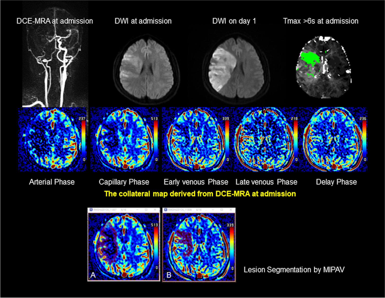 The collateral map: prediction of lesion growth and penumbra after acute anterior circulation ischemic stroke