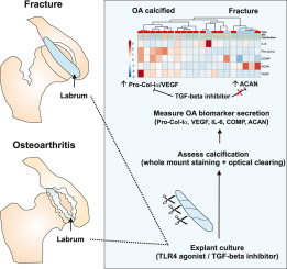 Elevated secretion of pro-collagen I-alpha and vascular endothelial growth factor as biomarkers of acetabular labrum degeneration and calcification in hip osteoarthritis: An explant study