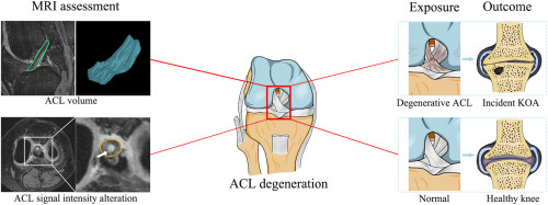 The association between anterior cruciate ligament degeneration and incident knee osteoarthritis: Data from the osteoarthritis initiative