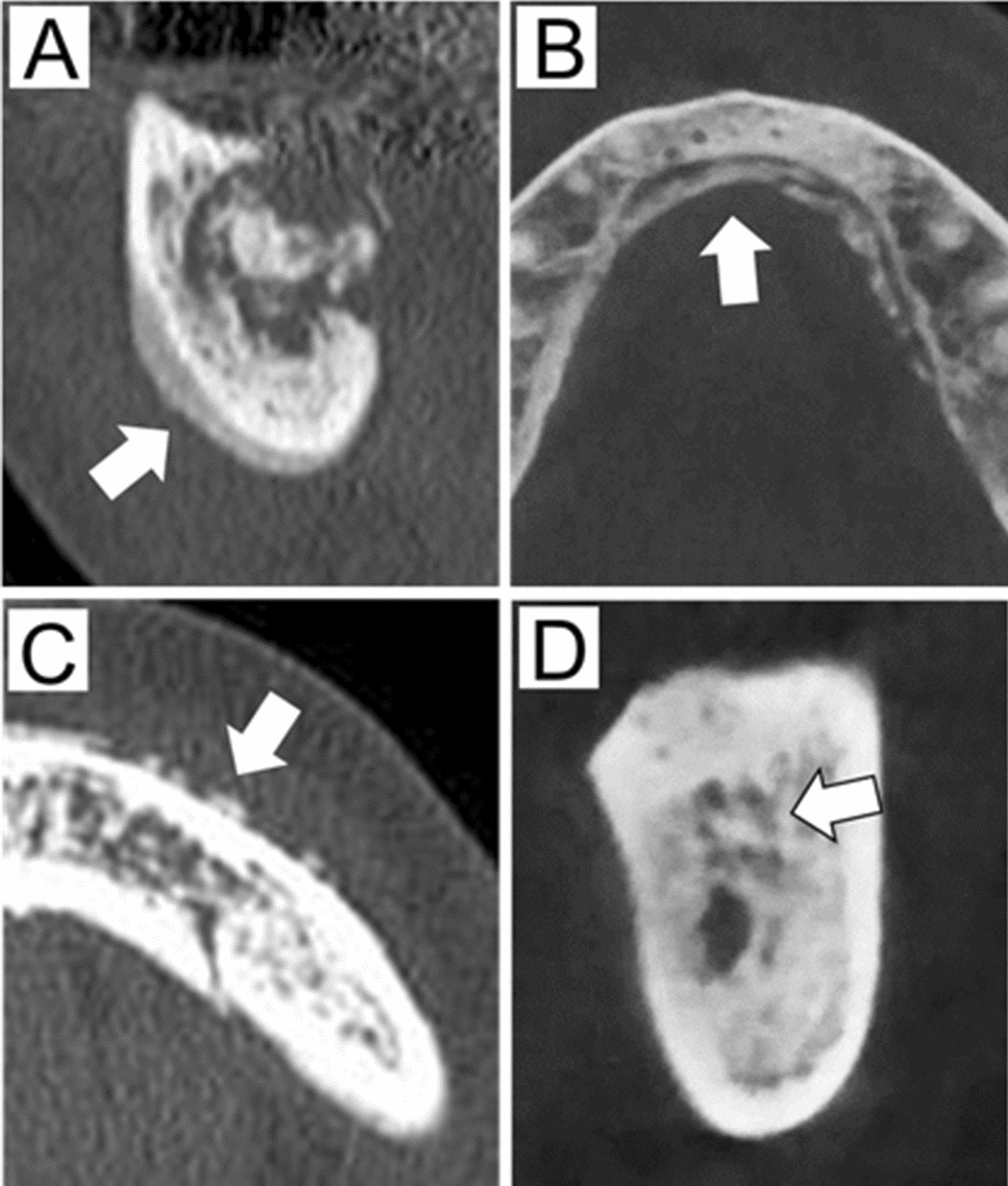 Medication-related osteonecrosis of the lower jaw without osteolysis on computed tomography images