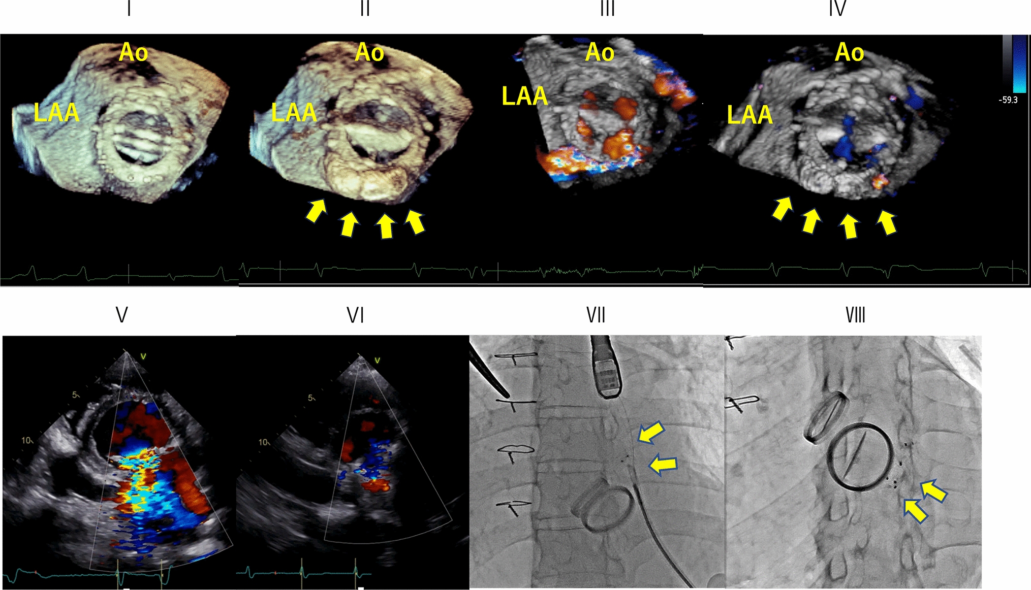 Transcatheter closure of mitral paravalvular leak by transapical approach with rectangular paravalvular leak device