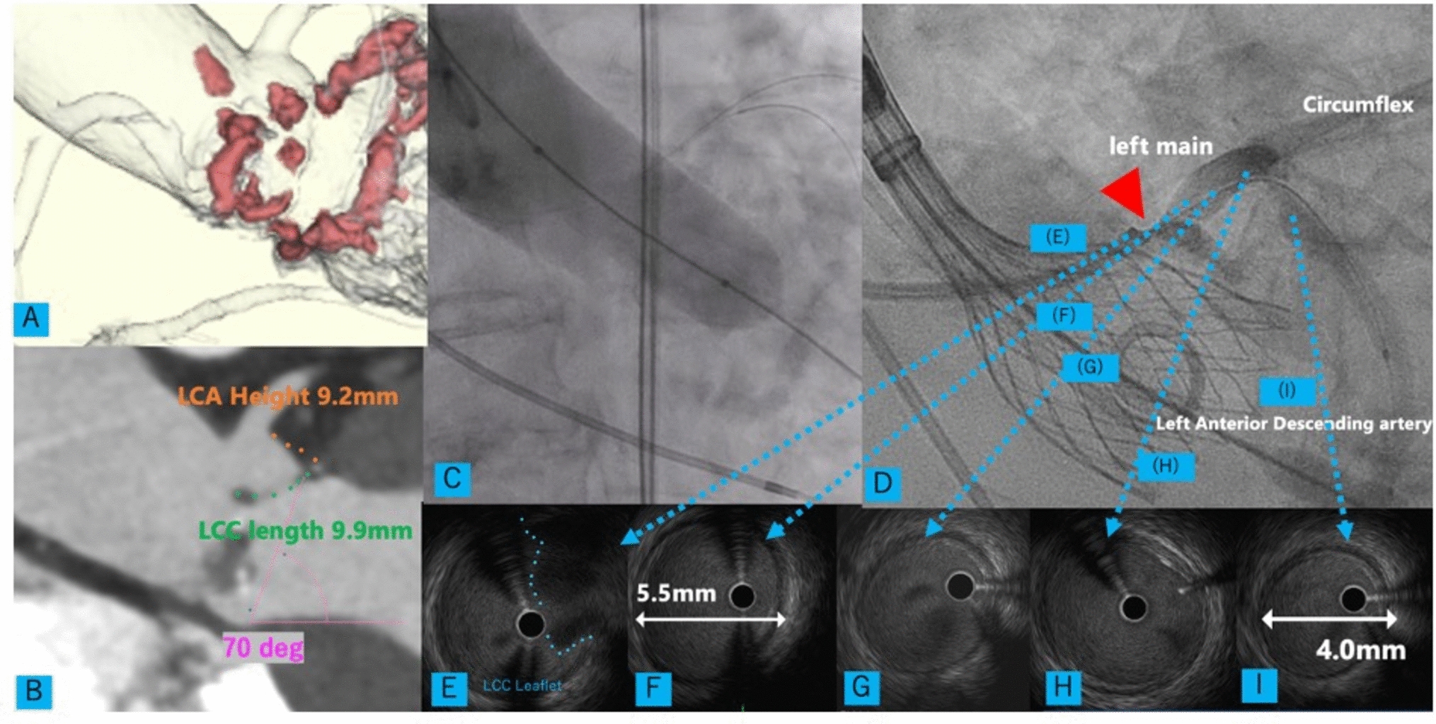 Intravascular ultrasound guide chimney stenting during transcatheter aortic valve replacement