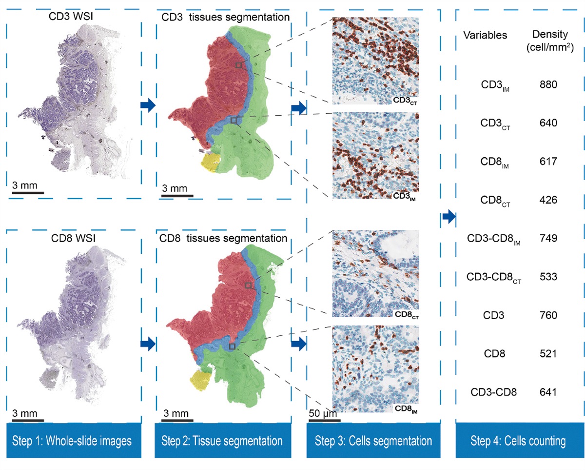 Artificial intelligence-based analysis of tumor-infiltrating lymphocyte spatial distribution for colorectal cancer prognosis
