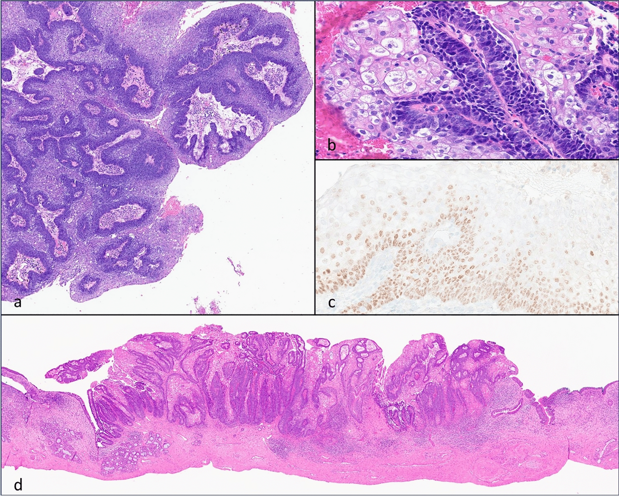 Sinonasal Differentiated Papillary NUT Carcinoma
