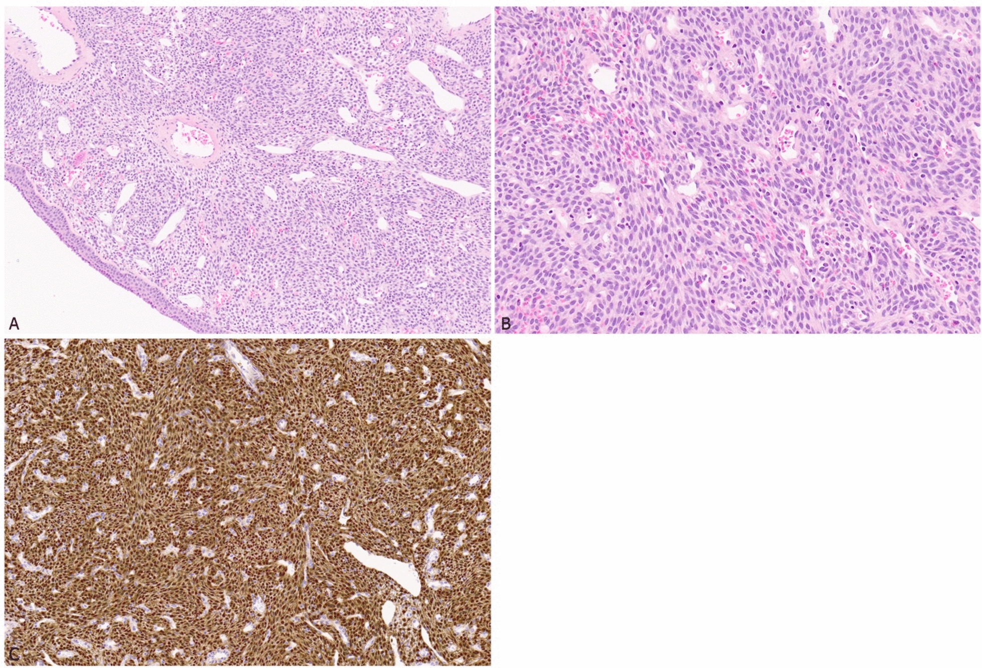 Spindle Cell Tumors of the Sinonasal Tract: A Diagnostic Update with Focus on Ancillary Workup