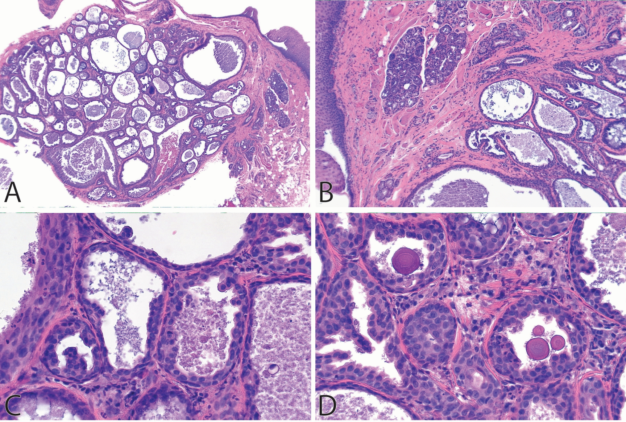 Dysgenetic Polycystic Disease of the Salivary Glands: A Case Report of This Rare Entity Occurring for the First Time in the Minor Salivary Glands of the Tongue, and a Review of the Literature