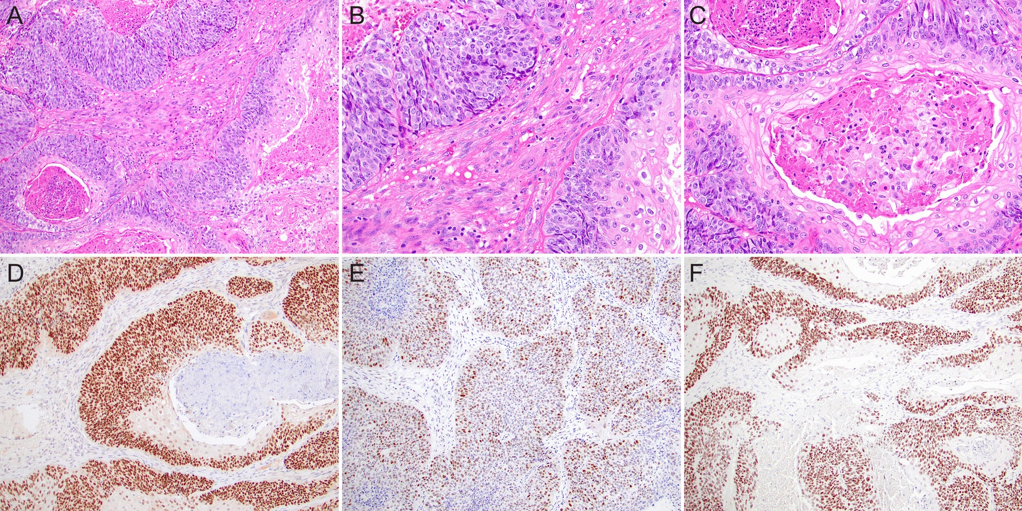 Top IHC/ISH Hacks for and Molecular Surrogates of Poorly Differentiated Sinonasal Small Round Cell Tumors