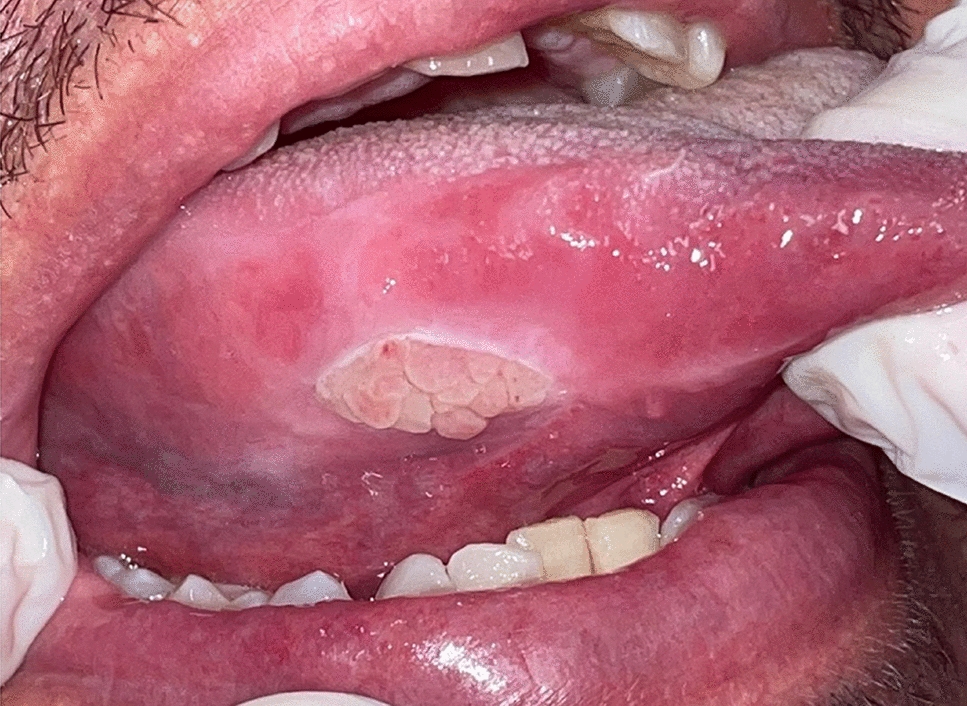 Traumatic Ulcerative Granuloma with Stromal Eosinophilia on the Tongue