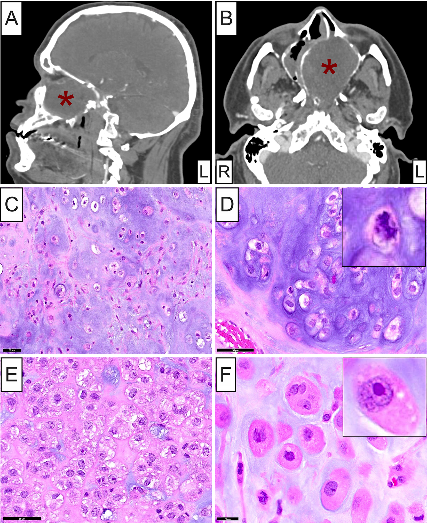 SMARCB1-Deficient Skull Base Chondrosarcoma with 12p Duplication Presenting as Somatic-Type Malignancy Arising from Metastatic Seminoma